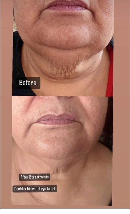 Double Chin Slim & Tone results SkinnyGlow